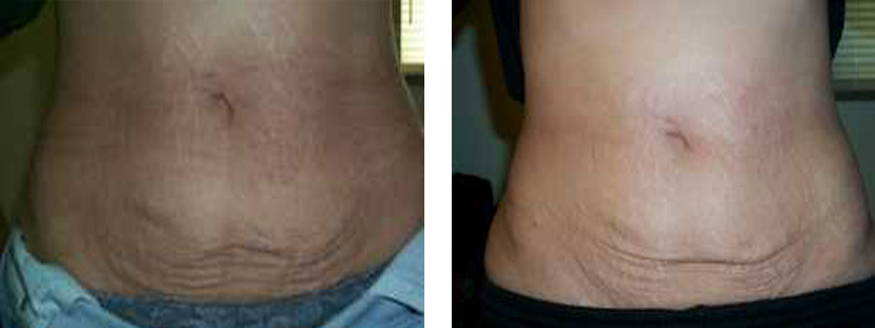 Stretch Mark Laser Removal | Cosmetic Laser Institute