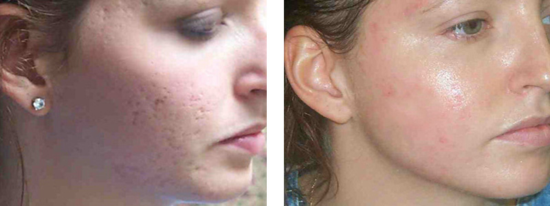 Image result for Laser Acne Scars Removal