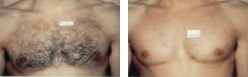 hair-chest-copy