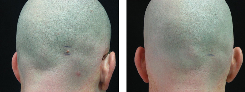 mole-scalp-copy