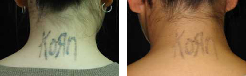 Tattoo Fading with Laser Treatments